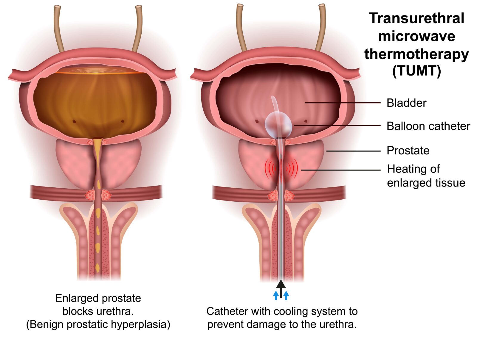 Transurethral Microwave Thermotherapy (TUMT)