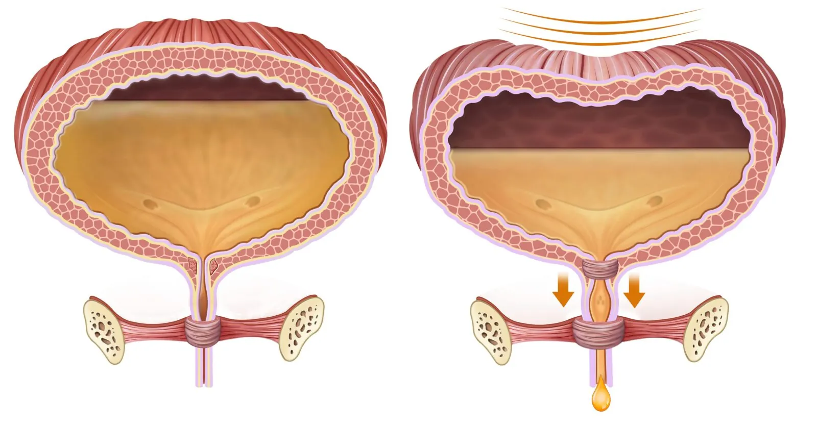 full vs. emptying bladder