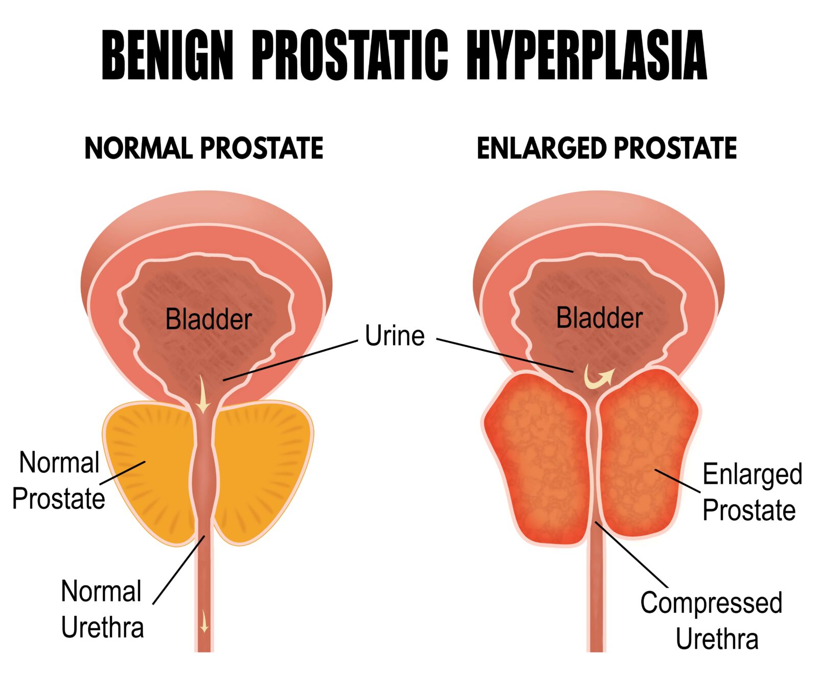 normal vs enlarged prostate