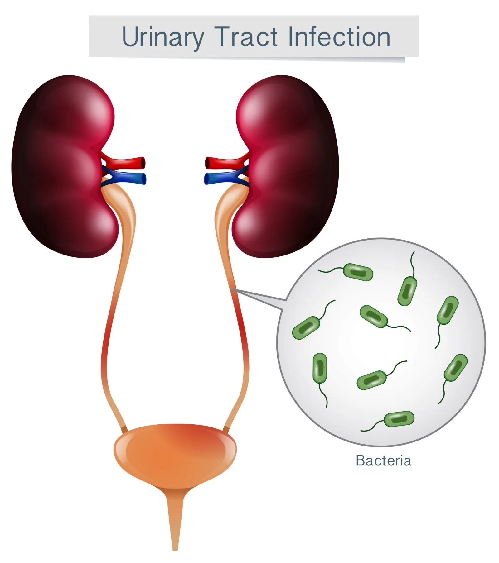 urinary tract infection