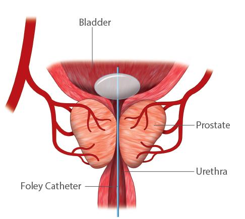 Prostatic Artery Embolization (PAE)