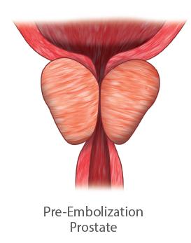 Pre Embolization prostate