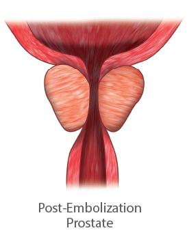 Post Embolization prostate