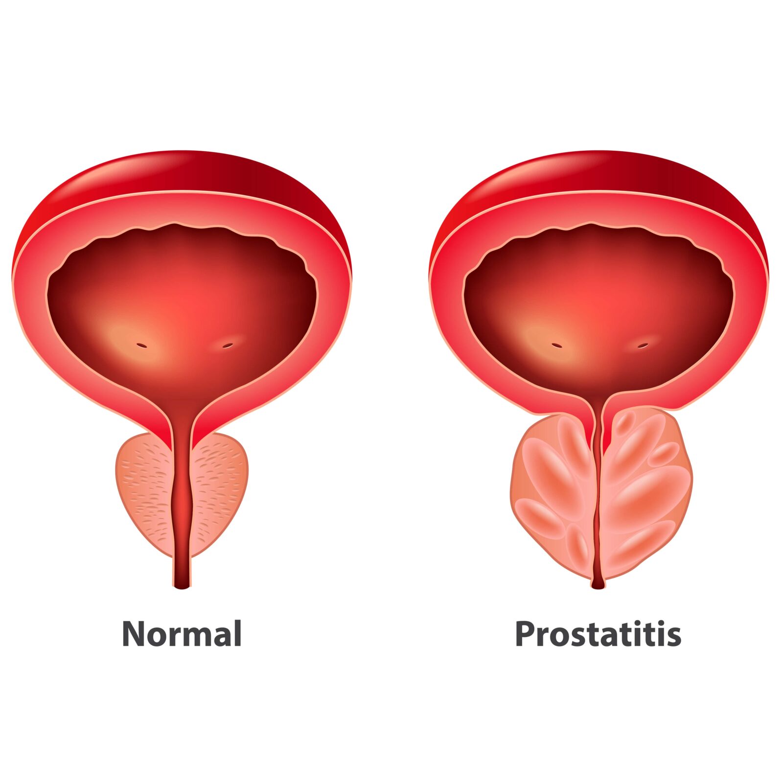 Prostatitis normal and inflamed prostate
