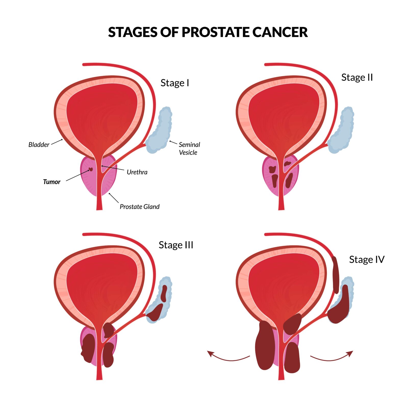 stages of prostate cancer