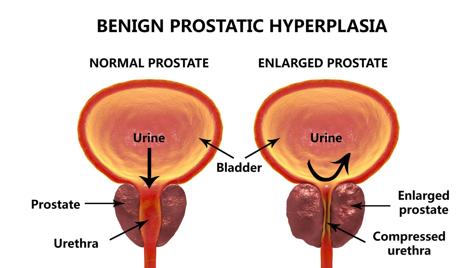 normal vs. enlarged prostate gland
